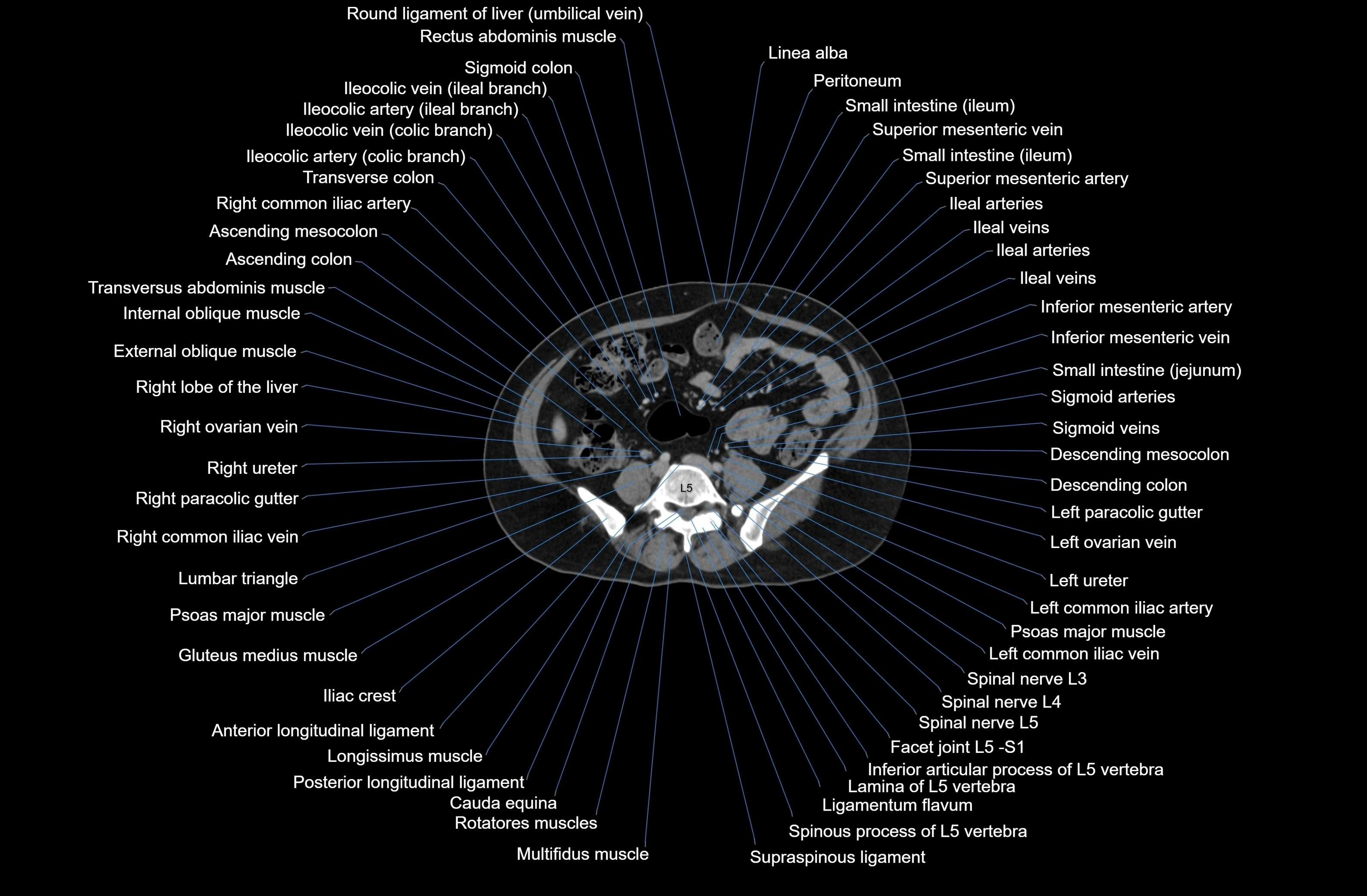 CT Abdomen axial cross sectional anatomy labelled radiology image-00059.webp